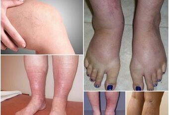 Photos Manifestation of varicose veins on tops