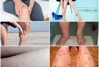 Symptoms of varicose veins on their feet