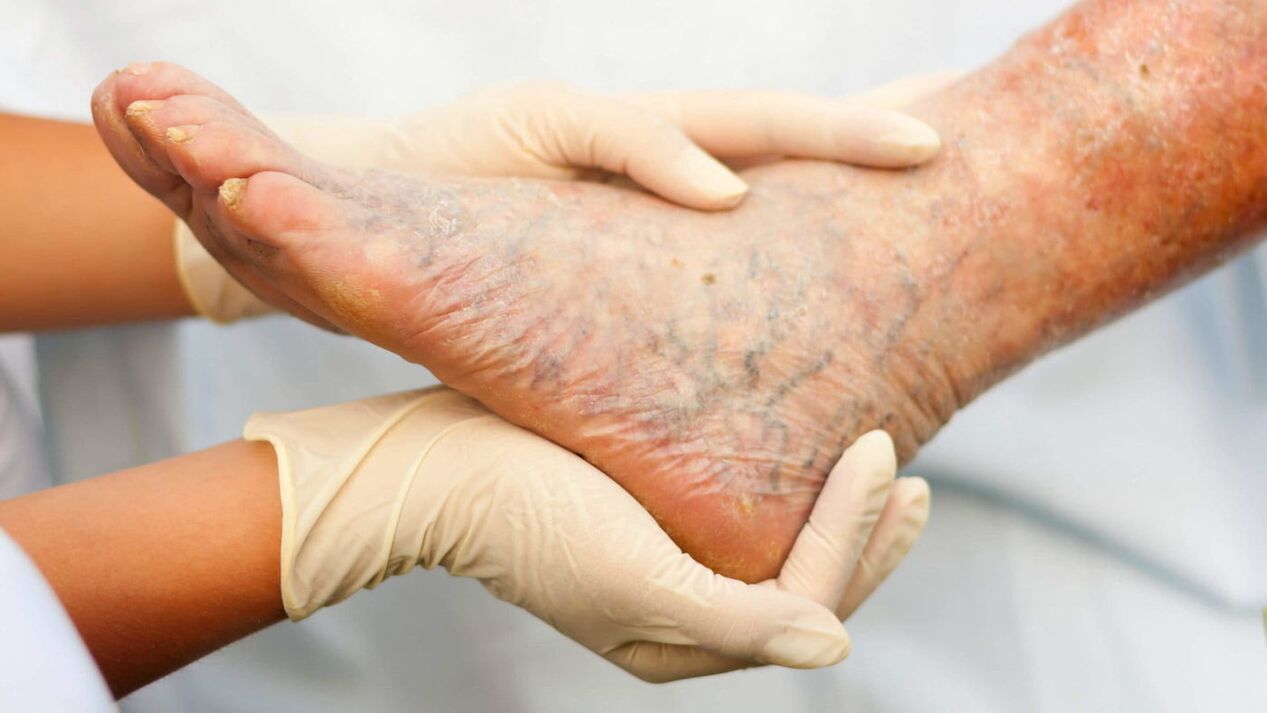 A phlebologist deals with the treatment of varicose veins on the legs