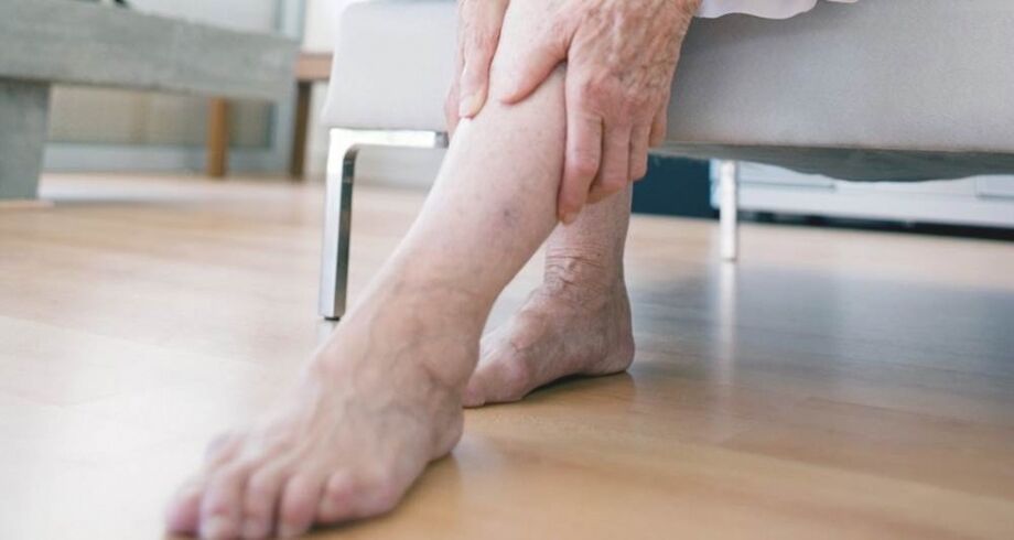 Varicose veins of the lower extremities caused by venous valve failure