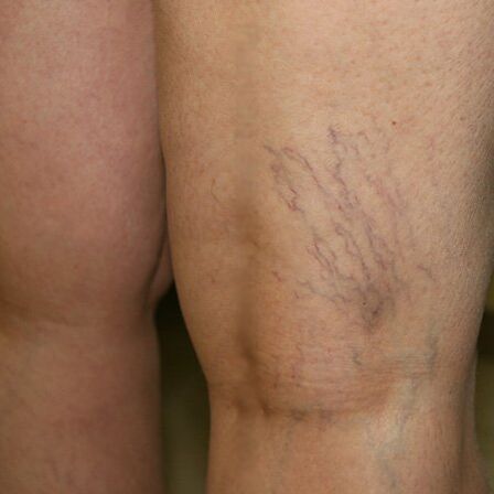 A venous network on the lower extremities is a sign of varicose veins