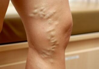 Varicose veins on female legs