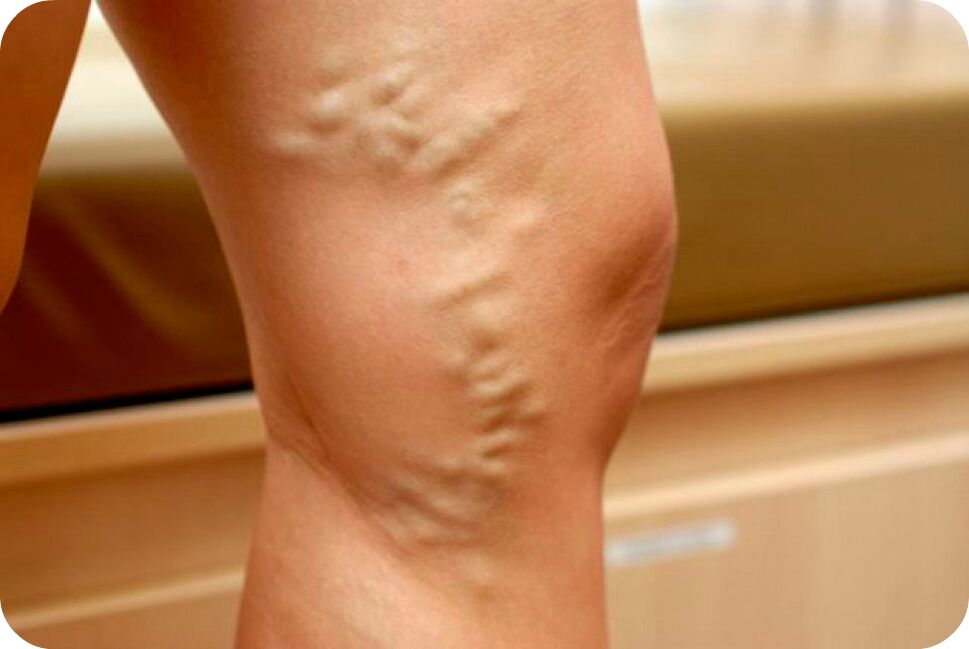 Varicose veins veins