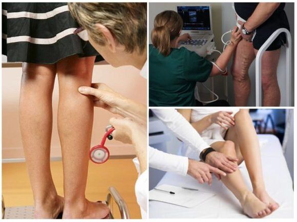 Varicose vein diagnosis