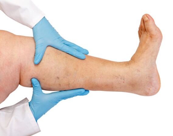 Varicose veins on their feet