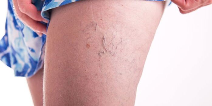 Varicose vein prevention