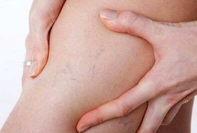 Forbidden actions for varicose veins