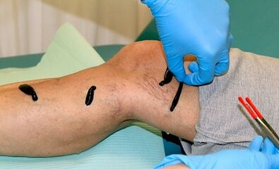 Surgery for varicose veins