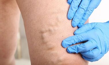 Varicose veins on their feet