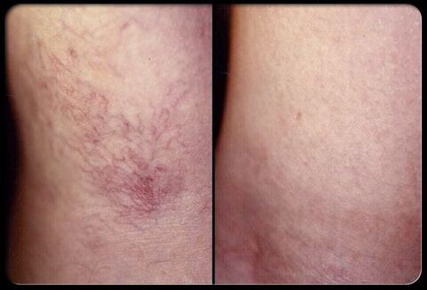 Before and after sclerotherapy