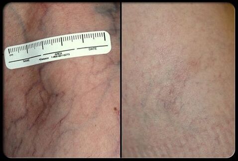 Before and after the process of laser therapy