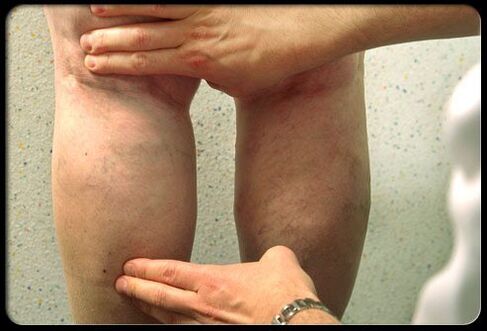 The doctor examines his feet with varicose veins