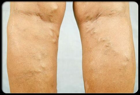Varicose veins on their feet