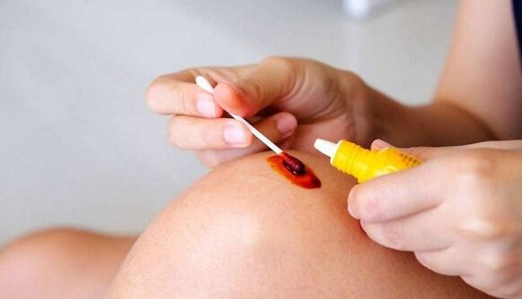Iodine for varicose veins