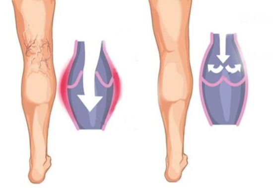 What varicose veins do look like